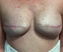 Areola Repigmentation by Artistry Of Permanent Makeup of Orange County