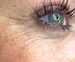 ProCell Therapies - Micro-Channeling by Artistry Of Permanent Makeup of Orange County