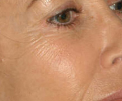 ProCell Therapies - Micro-Channeling by Artistry Of Permanent Makeup of Orange County